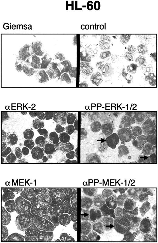 Fig. 5. Immunocytostaining of myeloid leukemia cells with PP-ERK-1/2 and PP-MEK-1/2 antibodies. / Cytospins of myeloid leukemia cells were stained with antibodies specific for ERK-2, PP-ERK-1/2, MEK-1, and PP-MEK-1/2 as described in “Materials and methods.” Approximately 1% to 5% of the cells were strongly stained with anti–PP-ERK-1/2 and anti–PP-MEK-1/2 antibodies. Note the nuclear staining of some cells, whereas others are stained mainly in the cytoplasm.
