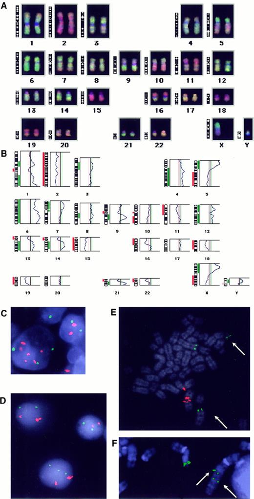 Fig. 2. Examples of CGH and FISH results. / CGH-karyotype (A) and ratio profile (B) obtained in case 19. The vertical green line is the threshold for overrepresentations; the vertical left red line is the threshold for underrepresentation. Gains (green) and losses (red) are blotted next to the ideogram. Heterochromatic regions (on chromosomes 1, 9, 13, 14, 15, 21) and chromosomes 19, 22, and Y were excluded from analysis. (C) FISH with centromeric probes for chromosome 6 (green) and 3 (red) performed on a frozen section from case 6 that showed overrepresentation of chromosome 3. 3 green and 6 red signals found in the “popcorn” cell confirmed the CGH result and indicated the triploid status of the analyzed cell. (D) Interphase-FISH with the chromosome 1 centromeric probe (red) and the chromosome 6 centromeric probe (green) in case 9. Malignant cells were hallmarked by double red signal due to the idic(1)(q10) (panel E). Note presence of 2 or 3 green signals in malignant cells. (E) Metaphase-FISH with the B5-2 cosmid (green) for BCL6 and the chromosome 1 centromeric probe (red) performed in case 9. Arrows indicate the split cosB5-2 signal on both derivatives of t(3;22)(q27;q11). (F) Partial metaphase-FISH with the cosB5-2 probe (green) in case 14 showing the split signal on der(3) (arrows) and on normal chromosome 3.