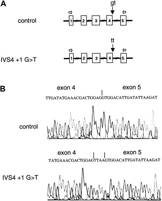 Fig. 1. Control and IVS4 mutant FGA constructs and direct sequencing of RT-PCR products. / (A) Control and mutant constructs used. The genomic FGAfragments contain the complete coding sequences from exons 1 to 4, complete introns 1 to 4, and part of exon 5. All the natural splice sites are therefore present in the insert. The oligonucleotides used for RT-PCR analysis are indicated by the white arrows. (B) Sequences of the uncloned RT-PCR products from COS-7 cells transfected with the control and IVS4 + 1 G→T mutant constructs. The IVS4 + 1 G→T donor site mutation leads to a 4-bp insertion (TTAA) between exons 4 and 5, due to utilization of a cryptic donor site situated 4-bp downstream.