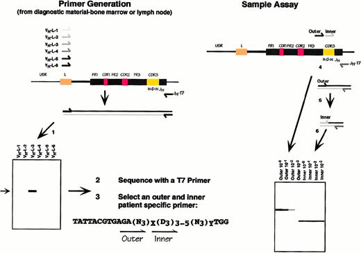 Fig. 1. Clonotypic PCR technique. / The CDR-III region is formed by the sequential D-JH and V-JH rearrangements in the pre-B cell. Both joins involve the addition of nontemplated “N” sequences and are therefore clone specific. (1) The V-D-J rearrangement is amplified by PCR using the family-specific VHL primers. A 550-bp product represents the rearranged VH allele. (2) The PCR product is sequenced directly, and primers are selected (3) from within the N-D-N region that are clonotypic. (4, 5) Samples are amplified in a semi-nested reaction and (6) are displayed on a high-resolution agarose gel.
