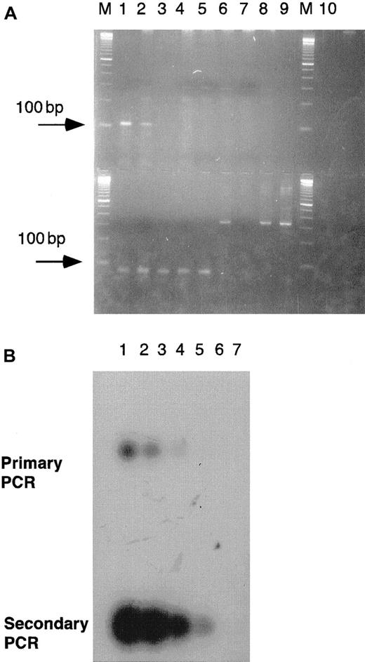 Fig. 2. Sensitivity of PCR versus hybridization of an internal probe to the first round product. / (A) Primary and semi-nested PCR demonstrating a sensitivity of one cell in 102 polyclonal cells after the primary round of amplification and one cell in 105 after the semi-nested second round. Primary PCR: serial 10-fold dilutions of 100 ng patient DNA derived from BM (approximately 104 cells) were mixed into 1μg polyclonal DNA (approximately 105 cells) extracted from normal PB mononuclear cells. Lane 1: positive control with 100 ng patient DNA, no polyclonal DNA. Lanes 2 through 8: log concentration of polyclonal versus patient DNA (eg, lane 2: polyclonal vs patient DNA is 100:1). Lane 9: negative control, 1 μg polyclonal DNA, no patient DNA. M: 100-bp markers. Semi-nested PCR: 1 μL 10−3 dilution of the first-round product serves as a template in the second round of amplification with the inner CDR-III clone-specific primer. Each lane corresponds to a dilution of the primary PCR product directly above it on the gel. Lane 10: no template from primary PCR. Anticipated product lengths were 101 bp and 75 bp for first- and second-round products, respectively. Lanes with an effective patient–polyclonal concentration of 10−6–10−8 are not expected to contain any malignant cells. The 350-bp product seen in lanes 6 to 9 reflects a nonspecific product amplified from polyclonal DNA with the clonotypic primers. (B) Demonstration of a sensitivity of 1 cell in 10−3 polyclonal cells after hybridization to a32P-labeled CDR-III inner primer. Hybridization of the probe to the semi-nested product serves as a positive control. The gel from Figure 3A was transferred by vacuum Southern blot and hybridized at 42°C to a 19-mer oligonucleotide in 6 × SSPE/1% sodium dodecyl sulfate (SDS). The filter was washed (6 × SSPE/1%SDS × 10 minutes × 3 at room temperature, followed by 1 × SSPE/1% SDS × 3 minutes at 42°C) and exposed overnight.