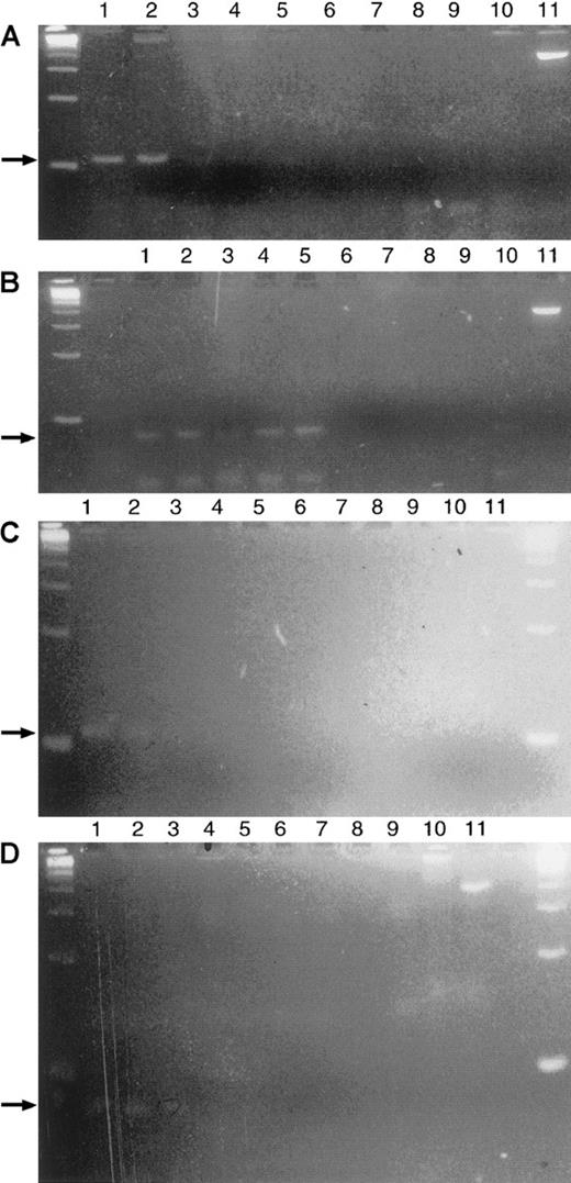 Fig. 3. Demonstration of clonotypic PCR before and after treatment in an nPR patient. / (A) Clonotypic PCR product in the initial pretreatment samples of this patient at a 10−4 dilution in the BM after primary PCR. (B) After seminested PCR, the clonotype is detected at a 10−4 dilution with greater intensity confirming the previous primary PCR result. (C) Persistent clonotype PCR after treatment from a nodular PR BM specimen for this same patient. Primary PCR detects a clone at a 10−2 dilution. (D) Seminested PCR confirms the primary PCR finding, detecting a clone at a 10−2 dilution. DNA was extracted from an aspirate corresponding to the bone marrow biopsy shown in Figure 4B. (A-D) Lanes 1-8, serial 10-fold dilutions of patient DNA starting with a 100 ng template; lane 9, negative control with no template DNA; lane 10, 1 ug polyclonal DNA; lane 11, positive control with bcl-2 primers and 100 ng of template.
