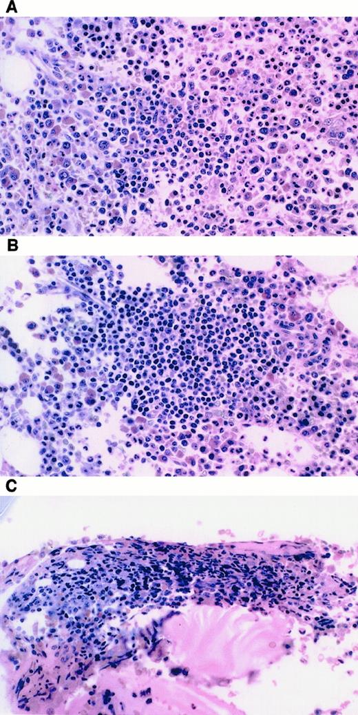 Fig. 4. Examples of bone marrow biopsies from patients achieving nPR. / (A) Patient 2: few irregular clusters of small lymphocytes. (B) Patient 4: several aggregates of small, round lymphocytes consistent with CLL. (C) Patient 7: 1-minute cluster of small lymphocytes, no identifiable lymphoma.