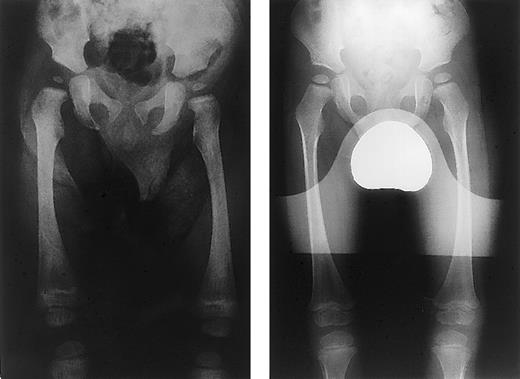 Fig. 1. X-rays before and after BMT. / X-ray prior to BMT (left panel) shows diffuse sclerosis of the femora and ileum along with Erlenmeyer flask deformity (metaphyseal widening) of the distal femora. One year following BMT (right panel), x-ray shows complete resolution of sclerosis and metaphyseal widening.
