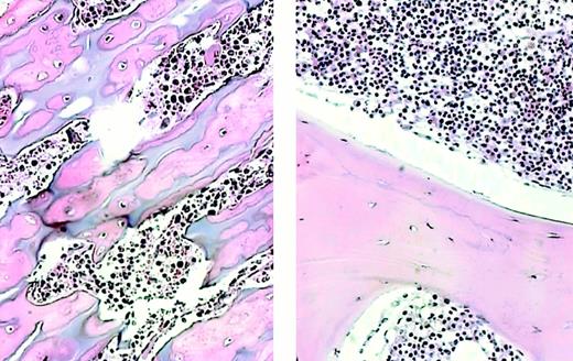 Fig. 2. Bony trabeculae before and after BMT. / Bone biopsy prior to BMT (left panel) shows bony trabeculae to be irregular and increased in number and to contain residual strips of unremodeled cartilage (blue-gray within the pink trabecular bone). Osteoclasts are not increased. The marrow cavity contains trilineage hematopoiesis but is markedly reduced. Post-BMT (right panel), the bony trabeculae are normal with no residual cartilage. The marrow space is expanded by cellular trilineage hematopoiesis. Both illustrations show hematoxylin-eosin–stained sections at 140 ×.