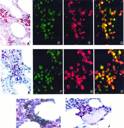 Fig. 5. Expression of VEGF-A and PlGF in human normal bone marrow. / (A) Expression of VEGF-A in the cytoplasm of erythroblastic island cells (APAAP technique, naphtol fast red) (black arrows). (B,C) Expression of VEGF-A (green, panel B) and glycophorin-A (red, panel C) examined by immunofluorescence. (D) Coexpression in erythroblasts is demonstrated by double immunofluorescence (yellow). (E) Expression of PlGF in the cytoplasm of erythoblastic island cells (APAAP technique, naphtol fast red) (black arrow). (F,G) Expression of PlGF (green, panel F) and glycophorin-A (red, panel G) analyzed by immunofluorescence. (H) Coexpression in erythroblastic cells is demonstrated by double immunofluorescence (yellow). (I) Double-immunoenzymatic staining: few macrophages stained in red with CD68 (PG-M1) (APAAP method, naphtol fast red) (black arrow). Macrophages are surrounded by VEGF-A–positive erythroblasts (APAAP method, NBT/BCIP revelation) (white arrow). (J) Erythroblasts showing cytoplasmic staining for VEGF-A (APAAP technique, naphtol fast red) are located in the vicinity of a sinusoid.