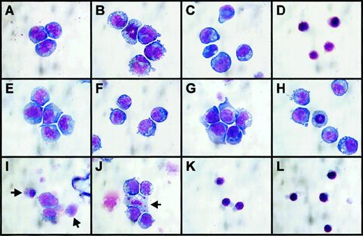Fig. 5. Morphology of cell lines incubated with AG957, AG490, and STI571 for 18 hours. / May-Grunwald-Giemsa stained cytospin preparations of cells incubated for 18 hours in media with FCS, growth factor, and inhibitor concentrations as listed. (A) FDC-P1 cells, 10% FCS + IL-3, no inhibitors. (B) FDC-P1 cells, 0.5% FCS + IL-3, no inhibitors. (C) FDC-P1 cells, 0.5% FCS + IL-3, STI571 = 10 μM. (D) FDC-P1 cells, 0.5% FCS + IL-3, AG957 = 50 μM. (E) FDrv210H cells, 10% FCS no IL-3, no inhibitors, (F) FDrv210H cells, 0.5% FCS no IL-3, no inhibitors. (G) FDrv210H cells, 0.5% FCS + IL-3, no inhibitors. (H) FDrv210H cells, 0.5% FCS + IL-3, AG490 = 5 μM. (I) FDrv210H cells, 0.5% FCS no IL-3, STI571 = 10 μM; arrows indicate 2 cells with fragmenting apoptotic nuclei. (J) FDrv210H cells, 0.5% FCS + IL-3, STI571 = 10 μM; arrow indicates one cell with fragmented apoptotic nucleus. (K) FDrv210H cells, 0.5% FCS no IL-3, AG957 = 50 μM. (L) FDrv210H cells, 0.5% FCS + IL-3, AG957 = 50 μM.