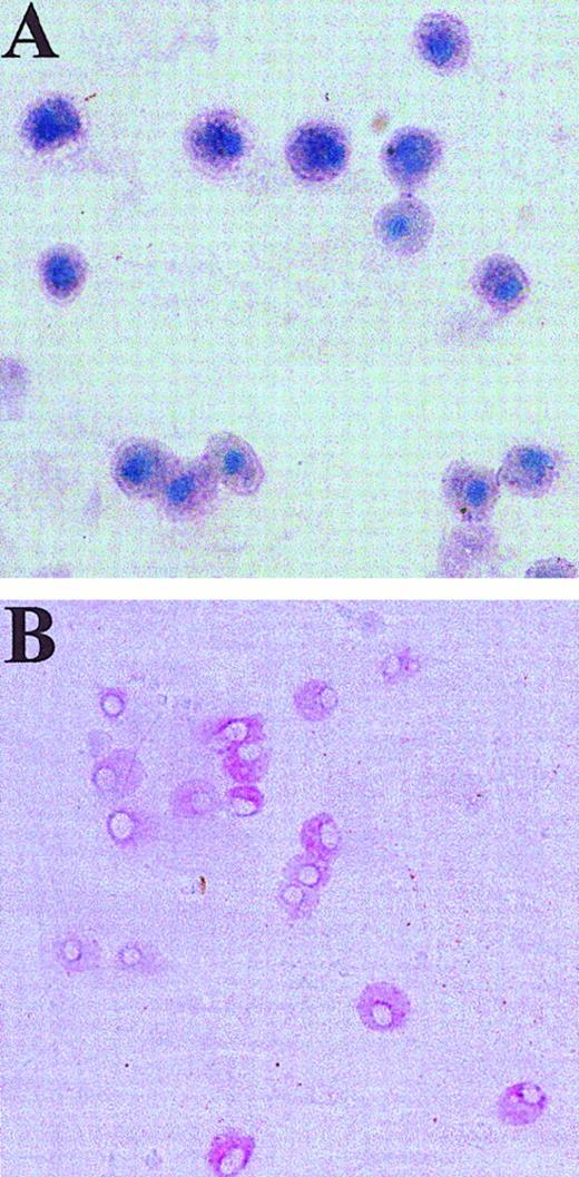 Fig. 5. Human skin-derived mast cells after GD3- and Kit-dependent immunoaffinity purification and coculture with fibroblasts. / Dispersed and density-dependent sedimentation-enriched skin-derived mast cells were purified using anti-GD3 mAb and were then labeled with PE-anti-Kit mAb. (A) A portion of these cells was placed on a slide, air dried, and stained with toluidine blue. Mast cells exhibit metachromatic purple cytoplasm and blue nuclei. (B) Another portion of these cells was subjected to sorting of individual cells onto fibroblast monolayers, which were then cultured with rhuSCF (100 ng/mL) for 3 weeks and stained with anti-tryptase mAb (naphthol AS-BI/new fuchsin). Positive cells stain red. Panel B shows a well containing multiple tryptase-positive cells. Original magnifications at the time of photomicroscopy were × 400 for panel A, and × 200 for panel B (inverted microscope).
