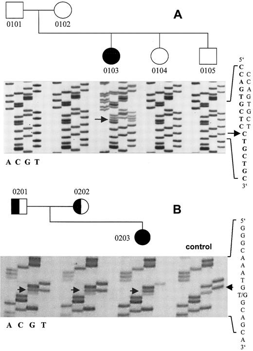 Fig. 2. Direct sequencing of the vWD 2A/IIE frameshift mutation 8566delC and the vWD 3 transversion 8512T>G. / (A) The mutation 8566delC in the translated region of exon 52 of the vWF gene predicts an aberrant and elongated translation product and is present only in the patient, not in either of her parents. The WT sequence is in boldface type. (B) The patient 0203 is homozygous for the transversion 8512T>G, which predicts the amino acid substitution C2754W; both parents are heterozygous. Numbers correspond to those in Table 1.