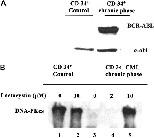 Fig. 4. Representative Western blot. / These blots show (A) BCR-ABL expression and (B) DNA-PKcs expression and the effects of proteasome inhibition in CD34+ cells from a patient with CML and in CD34+ control cells from a patient with a neuroblastoma. Cells were grown in the presence of rhGM-CSF for 4 hours, with 2 μM lactacystin (lane 4) or 10 μM lactacystin (lanes 2 and 5) and without lactacystin (lanes 1 and 3). Using 10 μM lactacystin, it was possible to reverse the down-regulation of DNA-PKcs in the CD34+CML cells.