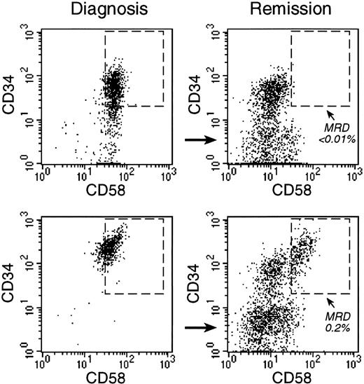 Fig. 3. Monitoring of MRD with anti-CD58 labeling. / Bone marrow cells from 2 children with B-lineage ALL were studied at diagnosis (left panels) and at the end of remission-induction therapy (right panels), when both patients were in complete morphologic remission. Flow cytometric dot plots illustrate the expression of CD34 and CD58 on CD19+ cells. In both patients, most CD19+ cells at diagnosis were CD34+ and CD58+. At the end of remission induction, CD19+CD34+CD58+ cells represented less than 0.01% of bone marrow mononuclear cells in one patient (top). In the other patient (bottom), 0.2% of cells expressed this phenotype, indicative of MRD. PCR amplification of Ig genes confirmed these findings (less than 0.01% and 0.4% MRD, respectively).