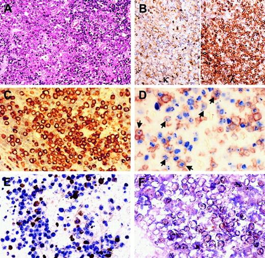 Fig. 1. Histologic and immunohistochemical study of KSHV-positive plasmablasts in lymphoproliferative lesions in case 1. / Plasmablastic lymphomas show confluent sheets of plasmablasts (A, hematoxylin-eosin) that express exclusively λ light chain (B) and high levels of cytoplasmic IgM (C). CD27 (brown), a marker for mature B cells, is expressed in 20% to 30% of KSHV-positive (blue) plasmablasts (D). Double staining shows that vIL-6 (brown) is strongly expressed in 10% to 15% KSHV-positive (blue) plasmablasts (E); hIL6-R (blue) is expressed in most KSHV-positive (brown) cells (F).