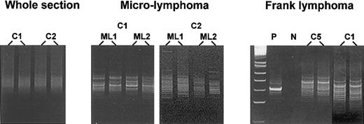 Fig. 2. Fr3-JH PCR analysis of KSHV-positive plasmablasts in MCD, microlymphoma, and frank plasmablastic lymphoma. / Whole sections of MCD-involved spleen show polyclonal patterns; microdissected microlymphomas display polyclonal (C2) or monoclonal (C1) patterns; frank plasmablastic lymphomas show monoclonal patterns. C1, C2, and C5 indicate different cases; P, positive control; N, negative control; ML, microlymphoma.