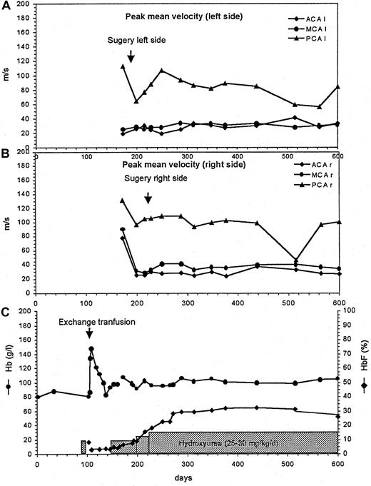 Fig. 1. Cerebral artery flow velocities measured by transcranial color duplex sonography. / Hb and HbF concentrations before and after cerebral artery surgery and during HU treatment. Peak mean flow velocities in the left (A) and right (B) anterior (ACA), middle (MCA), and posterior (PCA) cerebral arteries. Total Hb and HbF levels before and during HU treatment (C).