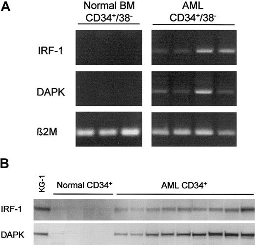 Fig. 1. Expression analysis of DAPK and IRF-1 in primitive leukemic and normal cells. / (A) RT-PCR was performed on the equivalent of 1000 purified cells from normal bone marrow (BM) or AML-derived CD34+/CD38− cells. Lanes 1-3 are independent normal marrow CD34+/CD38− cell specimens. The remaining 4 lanes are derived from independent AML blood specimens sorted to isolate CD34+/CD38− populations. PCRs for IRF-1 and DAPK are shown in the top and middle panels, respectively. The bottom panel shows control reactions using primers for β2-microglobulin. (B) Immunoblot analysis was performed to analyze IRF-1 and DAPK with the use of the equivalent of 400 000 cells per lane (each lane is an independent specimen). Samples were derived from flow-cytometrically sorted normal CD34+ cells (first 4 lanes after the KG-1 cell line control) or sorted AML CD34+cells (adjacent 9 lanes). From left to right, AML specimens were from FAB types M4, M1, M1, M2/6, M2, M4, M4, M5, and M4.