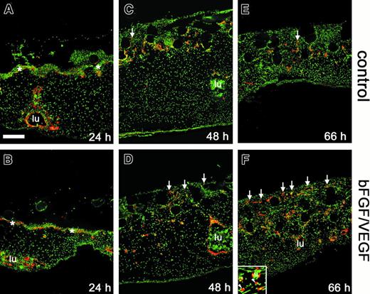 Fig. 3. Effect of angiogenic growth factors on endothelial cell invasion and vessel formation. / Collagen implants and underlying tissues were harvested from the CAM at 24 hours (A,B), 48 hours (C,D), or 66 hours (E,F), cryosectioned, and processed for immunohistochemistry. Endothelial markers (red) were detected by immunofluorescence in sections from implants that had been treated with buffer alone (A,C,E) or bFGF/VEGF (B,D,F). Sections were counterstained for nuclei (green). Immunostaining was performed using anti-VEGFR2/QUEK-1 IgG in conjunction with an amplification system, as described in “Materials and methods.” The subectodermal vascular plexus across the top of the CAM was apparent at 24 hours (asterisks in A,B) and was no longer discernible by 66 hours. New vascular sprouts (red endothelial staining) began to appear within the implants by 48 hours (C,D), with a clear angiogenic response seen at 66 hours (E,F). Arrows indicate some of the vascular sprouts that have entered the grids of the upper nylon mesh (clear circles) of the collagen implant. Large CAM blood vessels (lu) were frequently packed with nucleated red blood cells. Bar indicates 200 μm. Inset in panel F shows both blood vessels (lu) clearly containing nucleated red blood cells (green) and also endothelial staining that is not associated with an obvious lumen (arrowheads).
