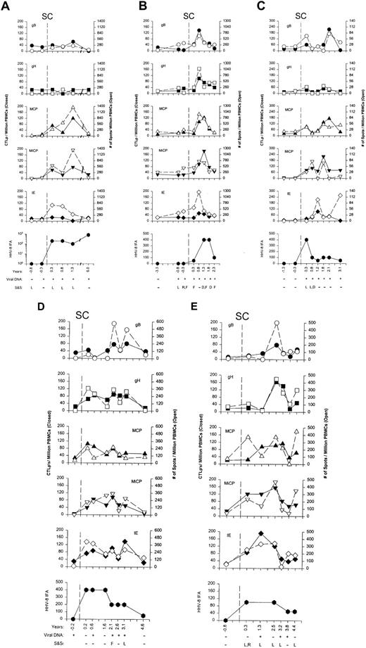 Fig. 1. Antigen reactivity. / (A-E) HHV-8–specific CTLp and IFN-γ production to 5 lytic cycle antigens, HHV-8 Ab titers, HHV-8 DNAemia, and signs and symptoms in subjects 20 to 24. CTLp's are shown as the closed symbols, whereas the numbers of IFN-γ–producing cells are the open symbols. SC is the estimated time of seroconversion; years are the times of the clinic visits before and after HHV-8 seroconversion; viral DNA is PCR detection of HHV-8 DNA in PBMCs; S&S represent symptoms of rash (R), fatigue (F), and diarrhea (D) reported by the study subject for the 6 month time interval before the specific visits, and signs of lymphadenopathy (L) detected on physical examination at the particular study visit.