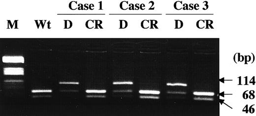 Fig. 2. D835 mutations were lost at CR. / In 3 AML patients, whose leukemia cells had the D835 mutations at the initial diagnosis, the mutations were lost at the CR. M indicates molecular weight marker (HaeIII digested pBR332 plasmid DNA); Wt, wild-type FLT3; D, diagnosis; CR, complete remission.