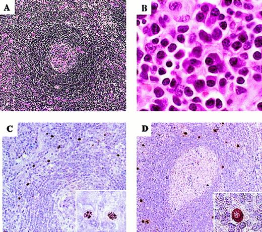 Fig. 1. Microscopic morphology of representative lymph node sections and immunohistochemical detection of KSHV infection. / (A) Small hyalinized germinal center surrounded by concentric layers of small lymphocytes (hematoxylin and eosin stain; × 100). (B) Interfollicular sheets of plasma cells are shown (hematoxylin and eosin stain; × 1000). (C) KSHV-LANA antigen detection in the lymph node mantle zone visualized by immunohistochemical staining with monoclonal antibody (× 200). The inset shows the characteristic speckled nuclear pattern (× 1000). (D) vIL-6 detection in immunoblastic cells in the lymph node mantle zone (× 100). The insets show specific cytoplasmic staining (× 1000).