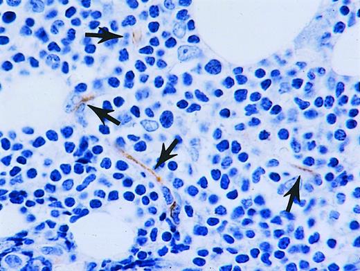 Fig. 1. Increased vascularity in CLL bone marrow. / Bone marrow trephine biopsy from CLL patient with several microvessels (arrows) highlighted by immunohistochemistry using antibodies to CD34.