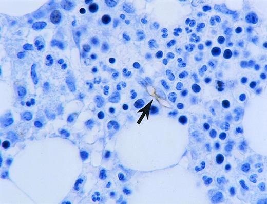 Fig. 2. Vascularity in control bone marrow. / Bone marrow biopsy from control with one microvessel (arrow) highlighted by immunohistochemistry using antibodies to CD34.