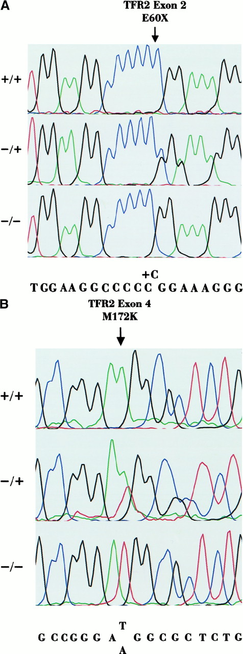 Fig. 2. Sequencing chromatographs. / (A) Sequencing chromatographs of the forward sequence of exon 2 spanning the C insertion, which originates the E60X mutation. Subjects VI-6 (+/+) and VI-2 (+/−) are shown compared to a healthy control (−/−). Position of the C insertion is indicated by the arrow. (B) Sequencing chromatographs of the forward sequence of exon 4 spanning the T515A (M172K) mutation. Subjects II-2 (+/+) and I-2 (+/−) are shown compared to a healthy control (−/−). Mutation is indicated by the arrow.