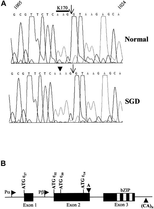 Fig. 1. The C/EBPε gene contains a frameshift mutation in a patient with SGD. / (A) Representative sequence chromatographs from a normal and an SGD patient from nucleotides 1005 through 1024 based on the previously deposited sequence.16 The nucleotide sequence is denoted across the top of the chromatograph. The arrows indicate the boundary between exon 2 and intron 2. The codon encoding amino acid residue lysine 170 (K170) is overlined in the normal sequence. The sequence was determined from 3 separate PCR reactions on the genomic DNA. A total of 12 clones from 3 separate PCR reactions were sequenced from both directions to verify the mutation. (B) Schematic drawing of the C/EBPε genomic locus indicates the 3 exons, translational start codons (ATG) for each isoform, the basic region–leucine zipper (bZIP) domain, and the 2 alternative promoters, Pα and Pβ. The downward arrowhead indicates the location of the A-nucleotide insertion in both panels. This would shift the open reading frame at the K170 codon and result in the lack of the bZIP domain in isoforms p32, p30, p27, and p14. The upward arrowhead indicates the position of CA-repeat microsatellite that is 35 bp 3′ of the polyadenylation site.