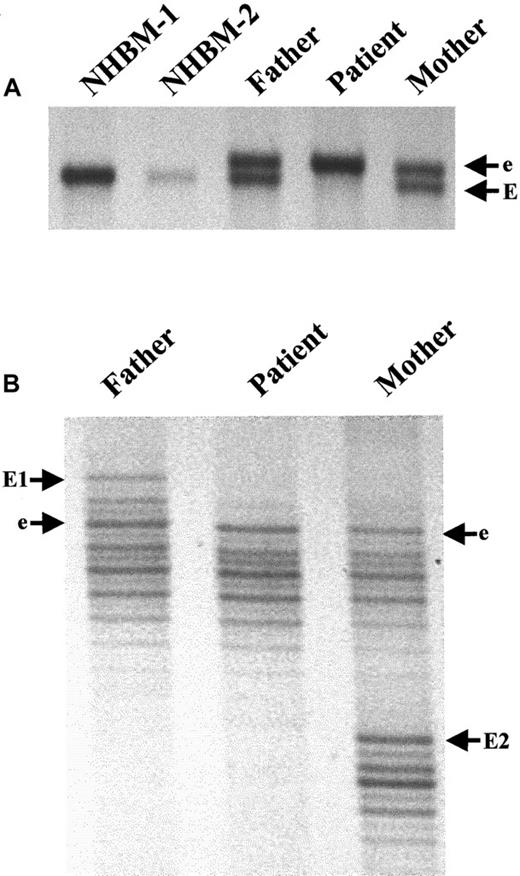 Fig. 2. Autosomal recessive inheritance of the mutant allele from a distant relative common to both parents of the proband. / (A) SSCP analysis demonstrates that genomic DNA from NHBM is homozygous for the wild-type allele, EE; the patient is homozygous for the mutant allele containing the A-nucleotide insertion, ee; and both parents are heterozygous, Ee. (B) Microsatellite analysis reveals that the mutant, e, but not the wild-type, E, alleles carried by the parents possesses the same “fingerprint,” indicating they inherited the mutant allele from the same distant relative.