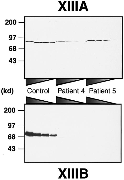 Fig. 1. Immunoblot analysis of XIIIA and XIIIB in patients' plasma. / Plasma samples were diluted at ratios of 1:5, 1:10, 1:20, and 1:40 for XIIIA, and 1:20, 1:40, 1:80, and 1:160 for XIIIB from the left to the right. Each sample was subjected to 8% SDS-PAGE under nonreducing conditions and immunoblot analysis using an anti-XIIIA or anti-XIIIB antibody.