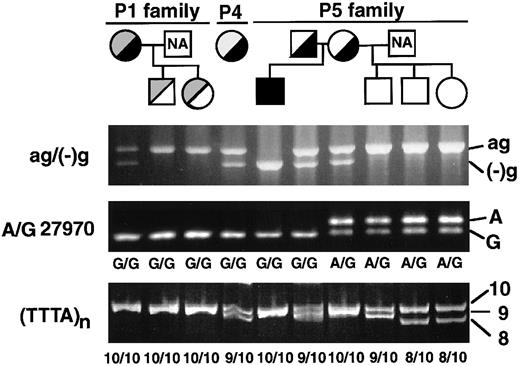 Fig. 3. Family pedigrees and genotyping of Japanese cases with the ag−(−)g mutation. / Black and gray fill-ins indicate the ag−(−)g mutation and other mutations, respectively. Genotypes for the ag−(−)g mutation and 3′-polymorphisms (A/G27970 and TTTA repeats) were determined in the patients and their family members.
