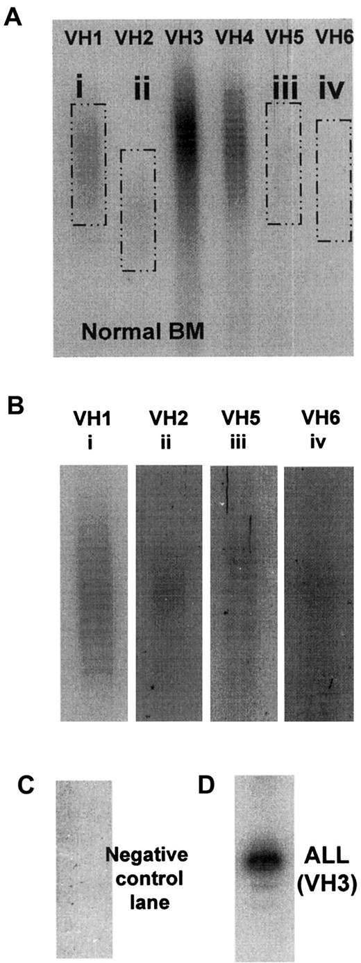 Fig. 1. Typical PAGE fingerprints showing usage of VH families in VH-(D)-JHrearrangements. / (A) Full fingerprint of normal BM; film exposed for 24 hours. (B) Darkened sections from panel A for visualization of faint bands. (C) Film exposed for 10 days and showing blank control. (D) Adult ALL consisting of a major VH3-positive clonal population; 24 hours' exposure.