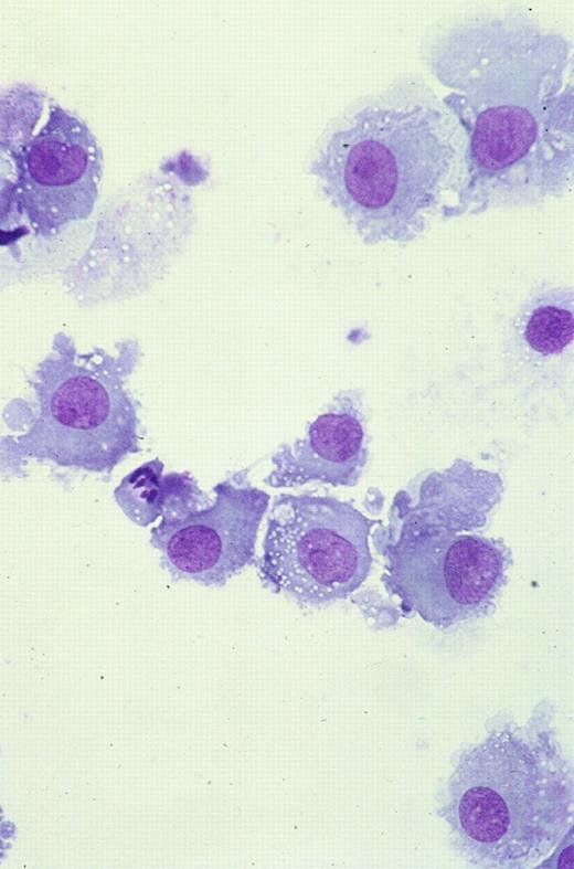 Fig. 1. Cultured leukemic DCs. / These are from patient 38 and demonstrate increase in size, copious gray cytoplasm, and development of cytoplasmic processes (Giemsa staining, × 50).