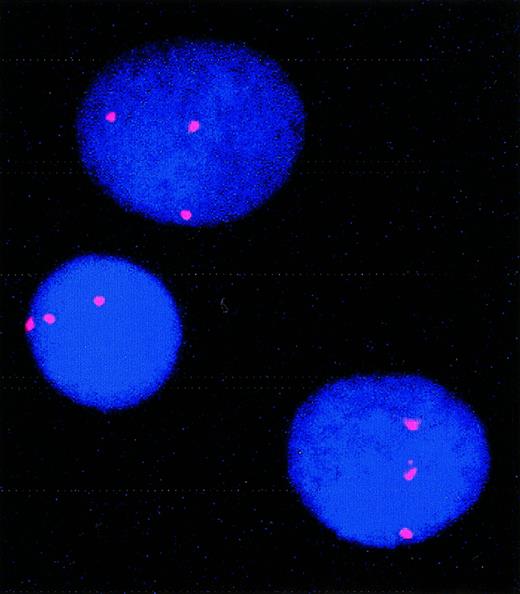 Fig. 2. FISH showing trisomy 8 in cultured cells from patient 5. / For this patient, 79% of cells carried trisomy 8 before culture; 55% carried trisomy 8 after culture.