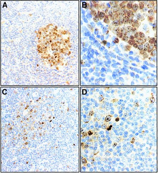 Fig. 6. Survivin expression in reactive and B-CLL lymph nodes (immunoperoxidase staining). / In reactive lymph node follicles, only germinal center cells are Survivin+ (A and B at 100 × and 400 × magnifications in a case representative of the 4 studied). In a B-CLL lymph node completely effaced by malignant cells, a minority of cells, which are located in pseudofollicles, stain with anti-Survivin antibody (C and D, at 100 × and 400 × magnifications in a case representative of the 4 studied).