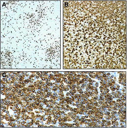Fig. 7. Serial section analysis of pseudofollicles in B-CLL lymph node (avidin-streptavidin-peroxidase staining with different combinations of mAbs). / In the same lymph node examined in Figure 6C-D, pseudofollicles contain numerous Ki-67 (ie, proliferating) cells (100 × magnification) (A). Few p27kip1+ cells are observed in a corresponding area on serial sections (100 × magnification) (B), whereas virtually all cells are intensely Bcl-2+ (200 × magnification) (C).