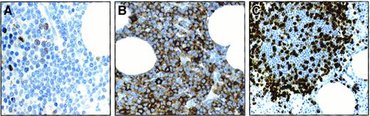 Fig. 8. Serial sections from a B-CLL BM biopsy infiltrated with CD5+ B-CLL cells (immunoperoxidase staining with different combinations of mAbs). / Clusters of Survivin+ cells are observed (A), scattered within a nodule of CD5+ malignant B lymphocytes (B). A large proportion of CD3+ T lymphocytes is interspersed in the same nodule (magnification A, B, C 200 ×) (C).