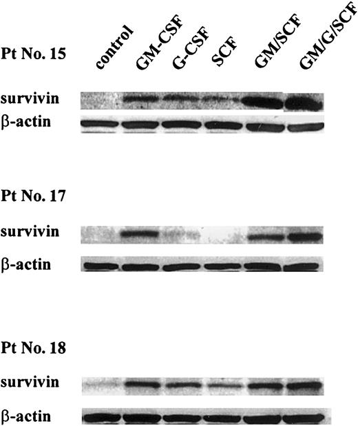 Fig. 3. Effect of cytokines on survivin expression in primary AML blast cells. / Cells were cultured in serum-free AIM-V medium with GM-CSF (100 U/mL), G-CSF (50 ng/mL), SCF (100 ng/mL), or various combinations of these cytokines for 48 hours. Then they were lysed, and survivinprotein levels were assessed by Western blot analysis. Results were quantitated by PhosphorImager. GM, GM-CSF; G, G-CSF; and Pt No., patient number as shown in Table 1.