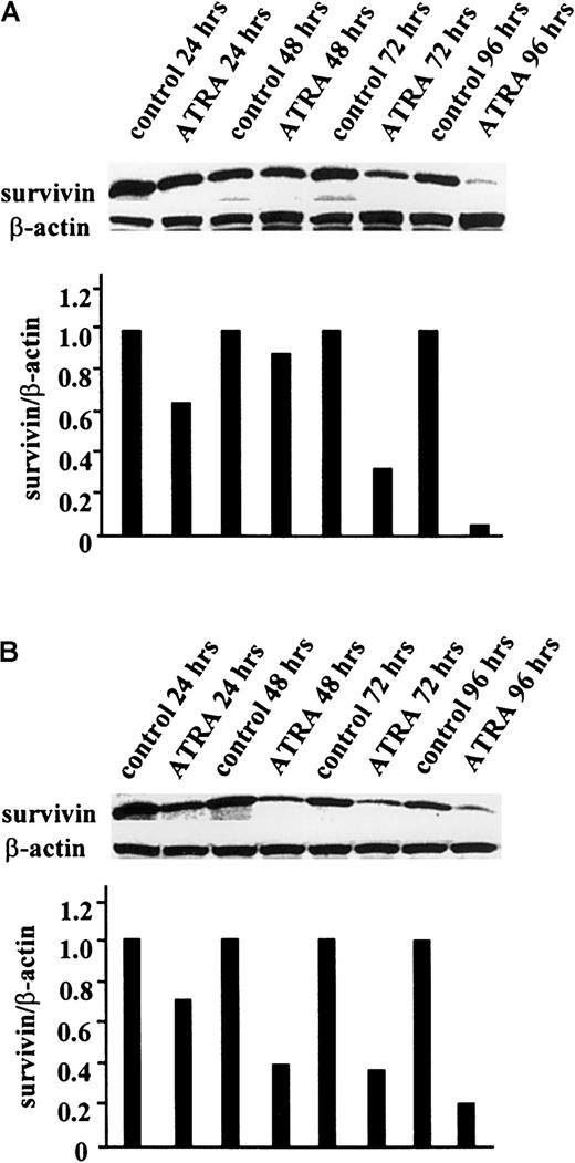 Fig. 4. ATRA-induced down-regulation of survivinprotein expression in HL-60 and OCI-AML3 cells. / HL-60 (A) and OCI-AML3 (B) cells were treated with 1 μM ATRA for up to 96 hours, as described in “Materials and methods.” Cells were lysed, and survivin protein levels were determined at 24, 48, 72, and 96 hours by Western blot analysis. The experiment was performed 3 times, and the results shown here are representative.