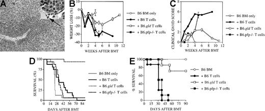 Fig. 1. Recipients of FasL-defective B6.gld donor T cells develop significantly less GVHD but do not die of leukemia. / All C3FeB6F1/J recipients received, on day 0, lethal irradiation (1300 cGy) followed by intravenous injection of B6 TCD-BM cells (5 × 106) and 32Dp210 leukemia cells (103). In addition, some recipients received splenic T cells (2 × 106) from normal B6, B6.gld, or B6.pfp−/− donors. (A) Recipients of B6 TCD-BM succumbed to leukemia, and hepatosplenomegaly was observed at autopsy. Hepatic tissue was preserved in formalin (10%) and embedded in paraffin, and tissue sections were stained with hematoxylin and eosin. Histopathologic examination revealed extensive periportal leukemic infiltration (large picture; original magnification, 100×), with many large anaplastic cells with pleomorphic, multilobular large nuclei and frequent mitotic figures (arrow, inset; original magnification, 1000×). Recipients of B6 TCD-BM only or B6 TCD-BM + B6.gld T cells developed less GVHD as determined by weight loss (B) and clinical GVHD score (C). The overall survival in recipients of TCD-BM + B6.gld was significantly better than in all other groups (D) (recipients of B6.gld T cells vs other recipients, P < .0001). Data from 2 combined experiments with 16 recipients per group are shown. This experiment was repeated without the inoculation of leukemia (E), and the survival of recipients of B6.gld was again significantly better than the survival of recipients of B6 T cells or B6.pfp−/− T cells. Each group consisted of 8 animals.