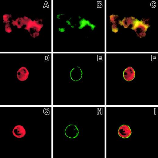 Fig. 8. Ligand binding to Mac-1 is required for the formation of Mac-1 clusters and F-actin patches in PMNLs challenged with P-selectin. / PMNLs, preincubated for 10 minutes at 4°C with 20 μg/mL control antibody (A-C) or anti-CD18 antibody IB4 (G-I) were challenged with 10 μg/mL P-selectin–IgG chimera. Alternatively, PMNLs were challenged with 10 μg/mL P-selectin–IgG chimera preincubated for 10 minutes with 20 μg/mL anti–P-selectin antibody, WAPS (D-F). Incubation in standard conditions was stopped at 2 minutes, and samples were processed for confocal laser scanning microscopy. A, B, and C show an aggregate of 4 cells. A, D, and G show F-actin staining, and B, E, and H show CD11b staining. In the overlay (C, F, I), yellow represents colocalization of the 2 stainings. The figure reports the results from a representative of 3 different experiments.
