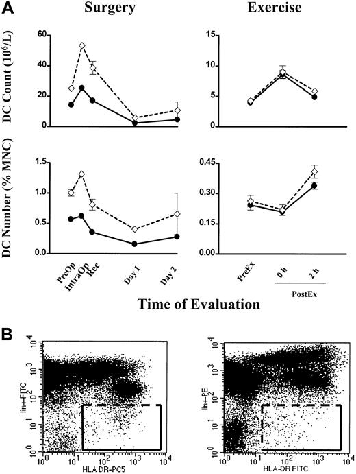 Fig. 4. Individual blood DC counts in surgery and exercise. / (A) Blood DC count (106/L) and DC number (percentage of MNCs) are plotted (●) for 2 individuals, one undergoing surgery (left column) and the other exercise (right column). For comparison, Lin− HLA-DR+ cells measured concurrently are plotted (⋄). Error bars show SEM. (B, left) A representative FITC versus PE–cyanin 5 dot plot showing the gating for Lin−HLA-DR+ cells used in the comparison above. (B, right) A dot plot for Lin− HLA-DR+ cells using the PE versus FITC combination of fluorochromes.