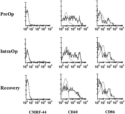 Fig. 6. Activation and costimulatory molecule expression of fresh DCs in surgery. / FACS analyses of fresh MNCs from a patient collected PreOp, IntraOp, and Recovery. DCs, defined and gated as Lin−HLA-DR+ cells, were analyzed for the expression of CMRF-44 (left), CD40 (middle), and CD86 (right). This result is representative of experiments from 4 patients.