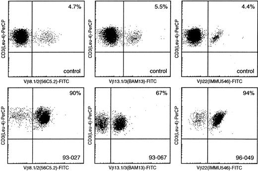 Fig. 1. Flow cytometric Vβ analysis in patients with mature T-cell proliferations compared with healthy controls. / Using Vβ8.1/8.2, Vβ13.1/13.3, and Vβ22 (FITC-labeled) double immunofluorescence stainings with CD3-PerCP, only small percentages of CD3+/Vβ+ cells can be identified in healthy controls (upper panel), whereas similar double stainings in samples 93-027, 93-067, and 96-049 enable identification of large T-cell populations with single Vβ8.1/8.2, Vβ13.1/13.3, and Vβ22 expression, respectively (lower panel).