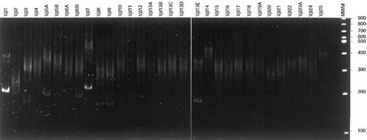 Fig. 3. Vβ-Cβ RT-PCR heteroduplex analysis. / After reverse transcription of total RNA of T-LGL patient 86-041, cDNA was PCR amplified using Vβ family primers in combination with a Cβ primer. On heteroduplex analysis, 2 major clonal products (Vβ1-Cβ and Vβ7-Cβ) belonging to the dominant clone were observed in addition to several weaker clonal Vβ-Cβ products. These latter products represented rearranged alleles of small subclones that were not identified with flow cytometric Vβ analysis.