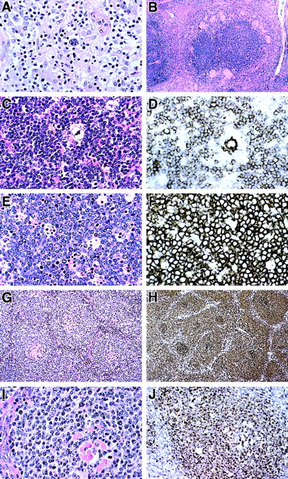 Fig. 2. Histopathology and immunopathology of lymphomas in ALPS patients. / (A) T-cell and histiocyte-rich B-cell lymphoma diagnosed in patient 3-II-3. Large polylobated tumor cells, which stained for CD20, are seen in a background of T lymphocytes and histiocytes. (B-D) Nodular lymphocyte-predominant Hodgkin disease diagnosed in patient 3-II-1. (B) A rim of epithelioid granulomas surrounds a large nodule containing neoplastic cells. (C) A single polylobated L&H cell is identified in a background of small lymphocytes. (D) A CD20+ L&H cell is rosetted by a rim of CD20− T cells. Numerous CD20+ small B cells are present in the background. (E) Burkitt lymphoma presenting as an omental mass in patient 26-II-4. Tumor cells are moderate in size with clumped chromatin and basophilic nucleoli. A prominent starry sky is present. (F) Tumor cells uniformly express CD20. The growth fraction was 100% with MIB-1 (Ki-67) staining. Identical histologic and immunophenotypic features were seen in lymphoma involving small bowel in patient 30-III-2. (G) An unusual form of follicular lymphoma was diagnosed in patient 55-II-1. Neoplastic cells surround hyalinized and possibly regressed follicular remnants. (H) CD20 immunohistochemistry emphasized follicular pattern. (I) The neoplastic cells are moderate in size with clumped chromatin. (J) A follicle-center origin for tumor cells is supported by Bcl-6 immunohistochemistry, which selectively stains the neoplastic cells within the follicles. Original magnification (A), ×400; (B), ×60; (C), ×400; (D), ×400; (E), ×400; (F), ×400; (G), ×200; (H), ×200; (I), ×400; and (J), ×250.