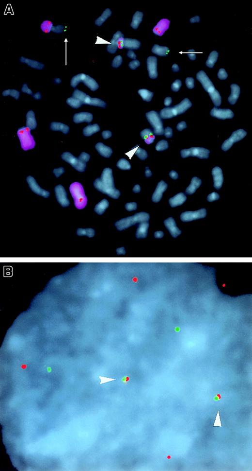 Fig. 3. Three-color FISH analysis of the KMM-1 MM line. / (A) CH (green), cyclin D3 cosmid (red), and chromosome 6 painting (purple) probes were hybridized to metaphase chromosomes (blue DAPI counterstain). Two copies of CH and cyclin D3 colocalize (arrowheads) on der(14). Two copies of CH (arrows) colocalize with VH and inserted c-myc (not shown). One copy of cyclin D3 is on normal chromosome 6, and 3 additional copies of cyclin D3 are on rearranged chromosome 6. (B) Interphase nucleus from (A) shows colocalization of 2 sets of CH and cyclin D3 probes (arrowheads).