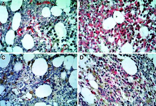 Fig. 2. Immunohistochemic staining of bone marrow sections. / Microvascular endothelial cells were highlighted by antibodies against thrombomodulin (A,C). VEGFR-2–positive leukemic blasts were identified by anti–VEGFR-2 antibodies (B,D). Immunohistochemic localization was performed by the alkaline phosphatase/anti–alkaline phosphatase bridge technique (Dako-APAAP Kit). A and B denote bone marrow samples obtained before; C and D, 8 weeks after treatment with SU5416. Original magnification, ×500.
