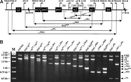 Fig. 1. Strategy and results of α-thalassemia multiplex polymerase chain reaction analysis. / (A) Schematic representation of the α-globin gene cluster, indicating extents of the 7 deletions and relative positions of the primers (except for the control LIS1-F and LIS1-R primers, which are located on a different chromosome). Locations of X, Y, and Z sequence homology boxes and hypervariable regions (HVRs) are also shown. (B) Multiplex PCR results from genomic DNA samples with various α-globin genotypes. M indicates Generuler 1kb DNA ladder (Fermentas, St Leon-Rot, Germany).