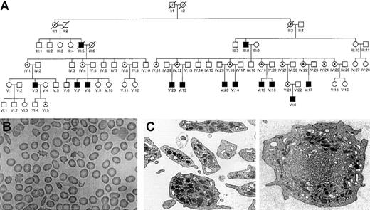 Fig. 1. Pedigree of affected family, light microscopy of red blood cells, and electron microscopy of platelets. / (A) Patients with the X-linked thrombocytopenia are represented by filled symbols, female carriers by dotted circles. (B) Light microscopy (magnification × 1000) of dysmorphic red blood cells in peripheral blood smear of affected patient after May-Grünwald-Giemsa staining, showing anisocytes, poikilocytes, megalocytes, and acanthocytes. (C) Electron microscopy (magnification × 12 600) of platelets. Left panel: platelets of a normal individual. Discoid platelets and more round forms with normal organelles and granules. Right panel: platelets of affected patient (representative of the 6 patients studied). Enlarged round platelet showing a cytoplasmic cluster composed of smooth endoplasmic reticulum and abnormal membrane complexes. Note paucity of alpha granules.