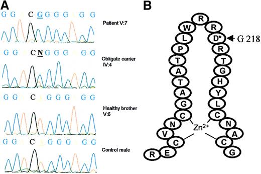 Fig. 2. Mutational analysis of GATA1. / (A) Sequencing analysis of GATA1 cDNA in patient V:7, obligate carrier IV:4, a healthy brother V:6, and a control male. A base pair substitution A to G was found at nucleotide position 653 in V:7 (hemizygous) and IV:4 (heterozygous). (B) This mutation results in a replacement of aspartate for glycine at position 218, located in the loop of the amino-terminal GATA1 zinc finger.